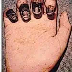 Plague Doctor Methods Hand Bubonic Plague