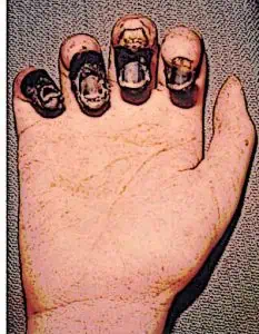 Plague Doctor Methods Hand Bubonic Plague